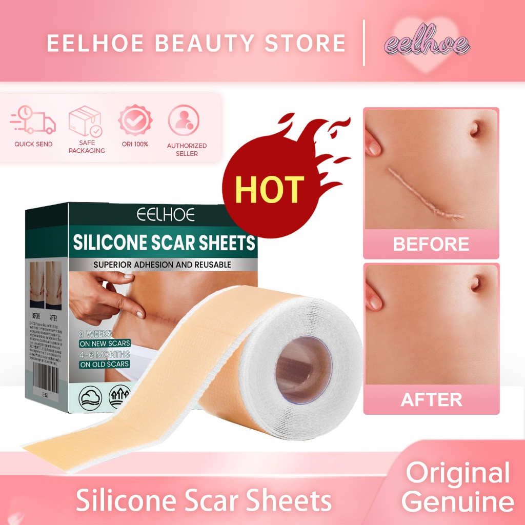 EELHOE Silicone Scar Sheets 1Roll Plester Silikon Penghilang Keloid Bekas Luka Silicon Keloid Pleste