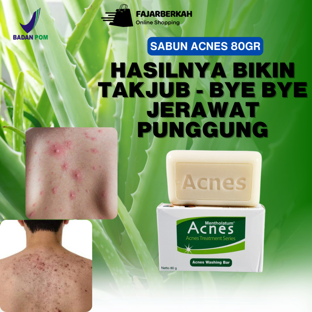 Sabun Jerawat Punggung - Obat Jerawat Punggung Merah - Penghilang Bekas Jerawat Punggung Hitam