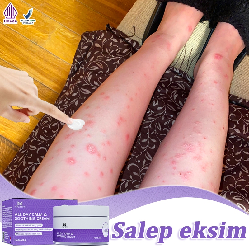 【BPOM】Salep eksim salep gatal eksim paling ampuh salep gatel 20g salep gatal china paling ampuh Kuli