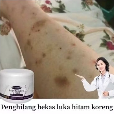 Sweetrip Scar Remover salep penghilang bekas koreng bekas luka hitam bekas gigitan nyamuk
