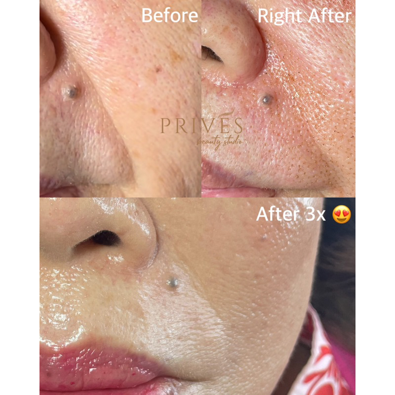 Plasma Lifting Fibroblast by Owner