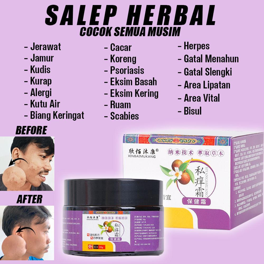 Salep gatal XINBAIMUKANG paling ampuh Obat psoriasis obat gatal salep kutil Obat Gatal Salep gatal