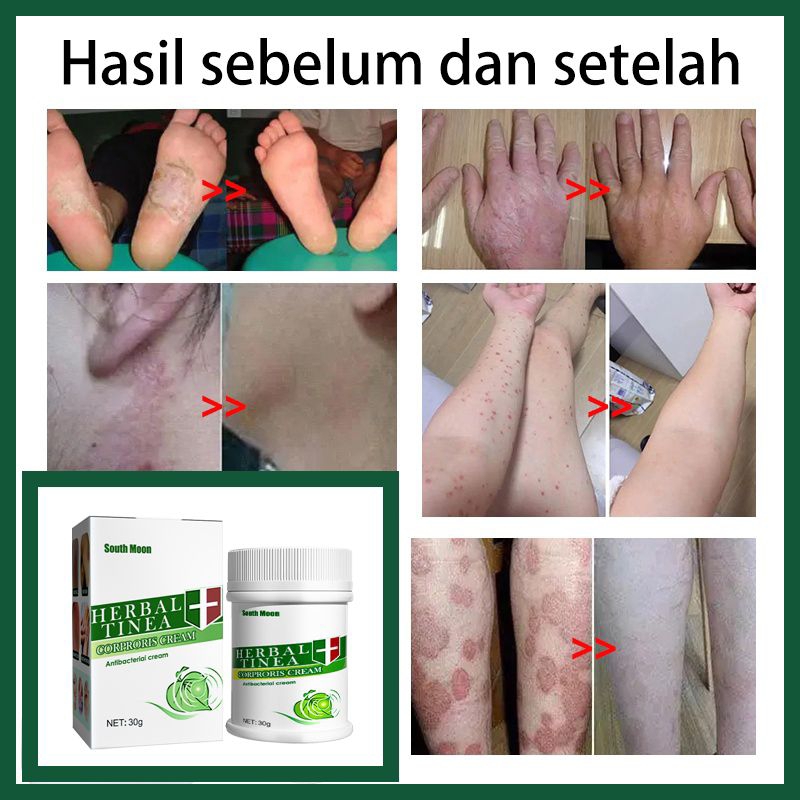 HERBAL TINEA Salep gatal dan kurap 30g