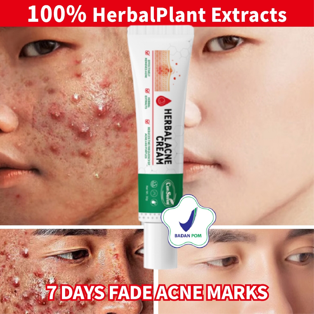 【BPOM】krim penghilang jerawat herbalife original 100%,krim jerawat dan bruntusan,krim jerawat efekti