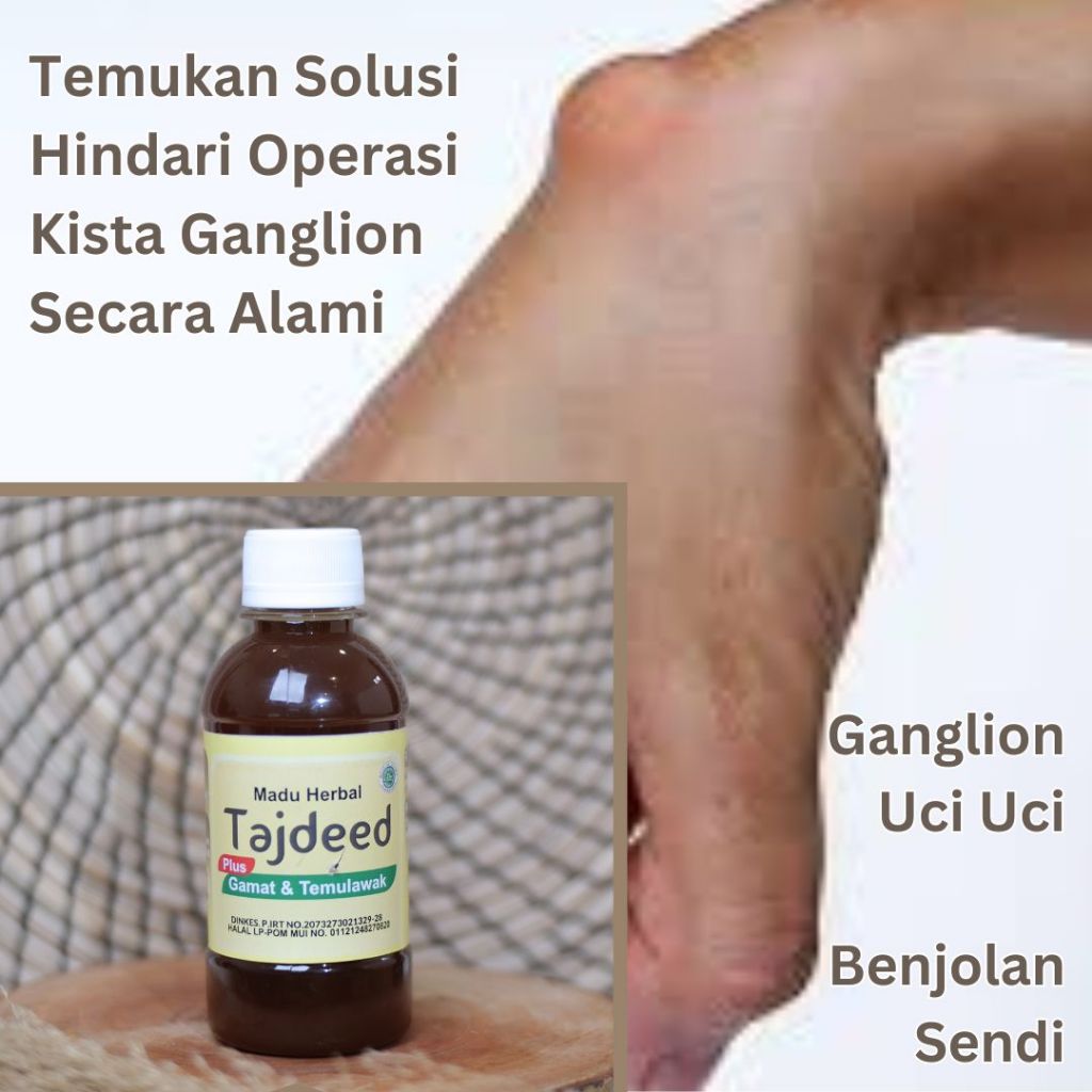 Obat Kista Ganglion Paling Ampuh Di Apotik Herbal Tradisional Alami | Obat untuk Menghilangkan Uci U
