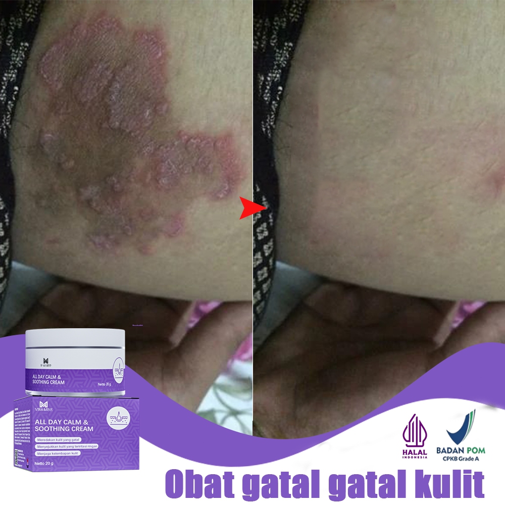 Obat kurap salep gatal selangkangan salep gatal china paling ampuh obat gatal kulit salep gatel 20g