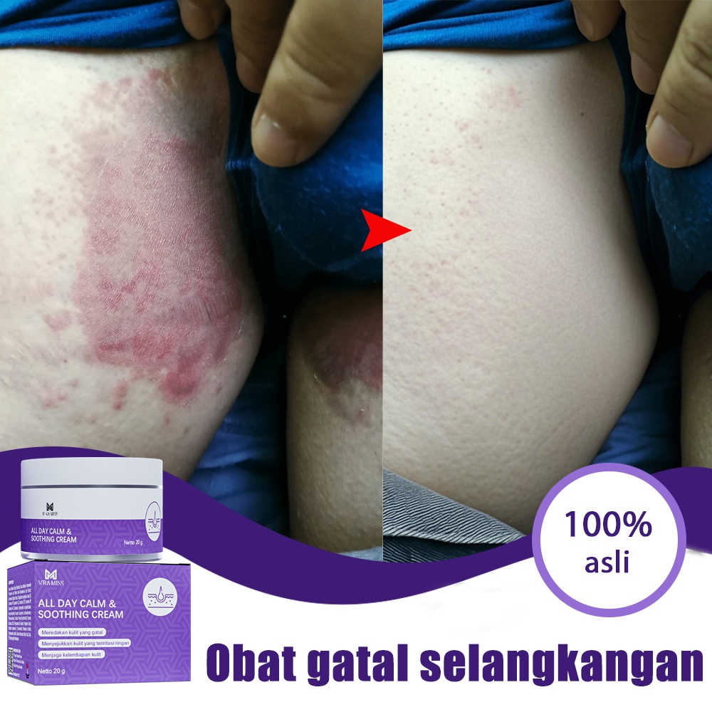 Obat kurap salep gatal selangkangan salep gatal china paling ampuh obat gatal kulit salep gatel 20g