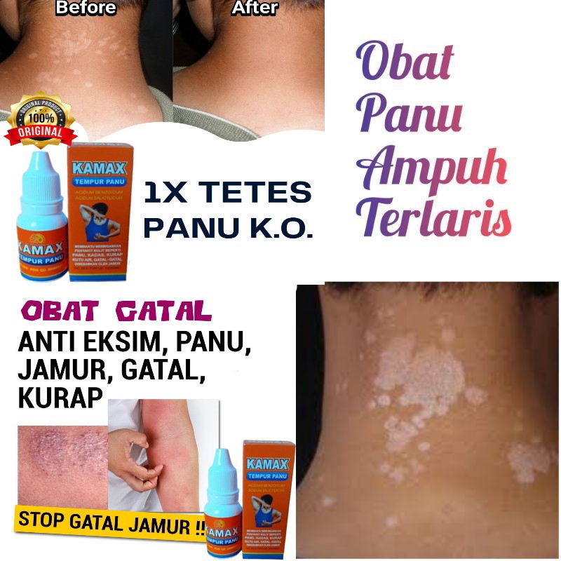 Obat Panu Kadas Kurap Paling Ampuh Asli Kamax Cair Bpom Tempur Panu