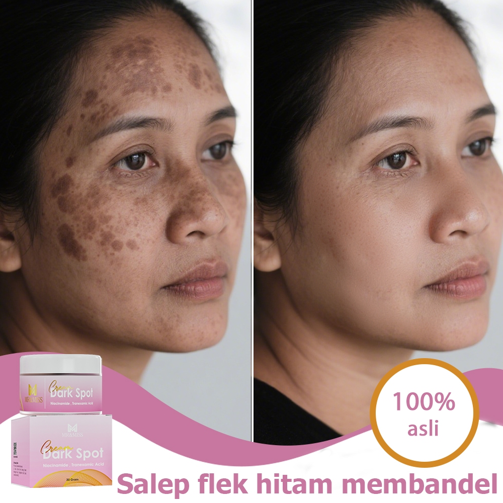 【BPOM】Salep flek hitam membandel menghilangkan flek hitam di wajah krim pemutih wajah bpom 30g