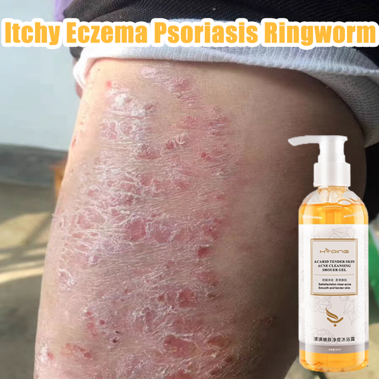 sabun gatal kulit ampuh sabun mandi gatal kulit ampuh sabun jerawat punggung acne body wash