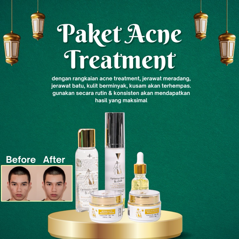 [OPTIMIZE SHINE] PAKET ACNE PACKAGE || HEMPASKAN JERAWAT & BEKAS JERAWAT