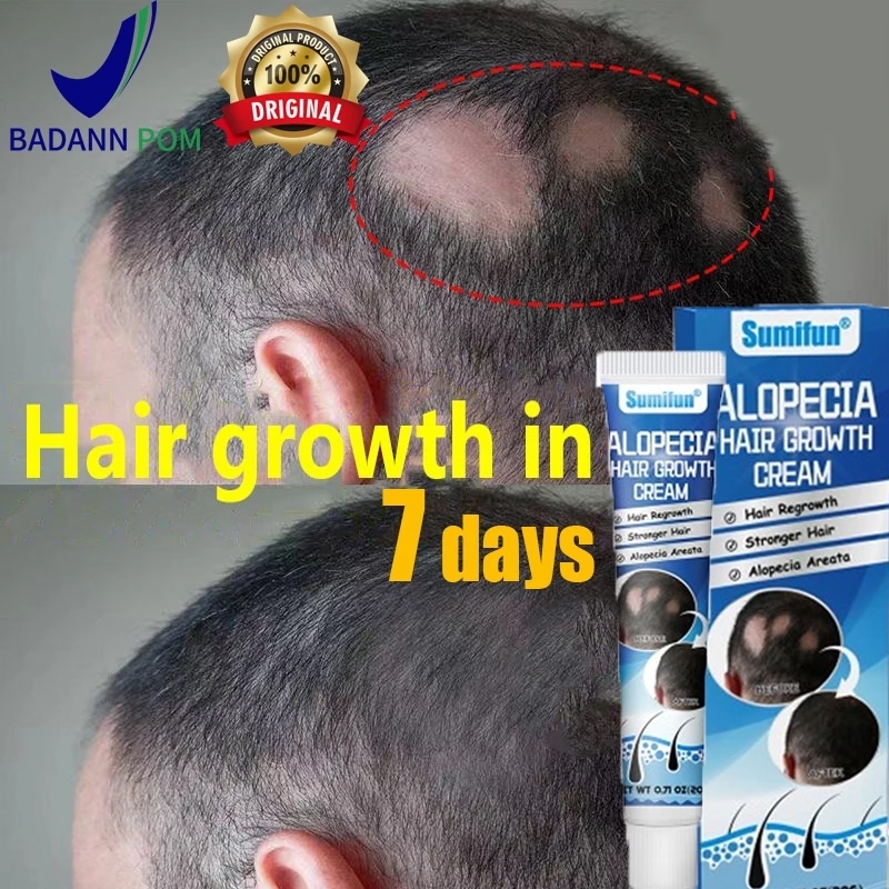 Obat Alopecia Areata, Obat Penumbuh Rambut Rontok cepat 20g penumbuh rambut cepat serum, penumbuh ra