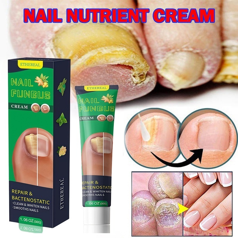 Obat Jamur Kuku Obat Kuku Jamur Dan Rusak Perawatan Jamur Kuku Pemutih Kuku Penghilang Jamur Kuku Ge