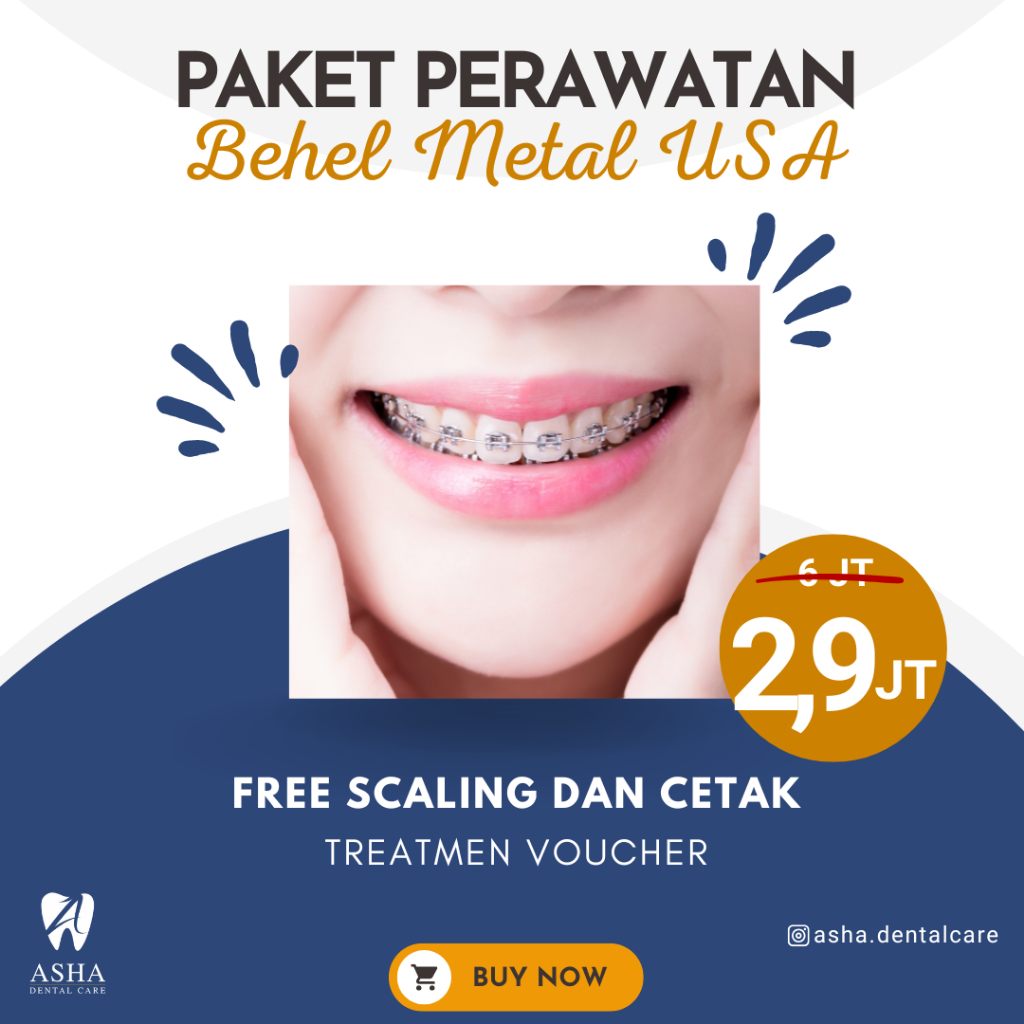 Promo Behel Metal USA