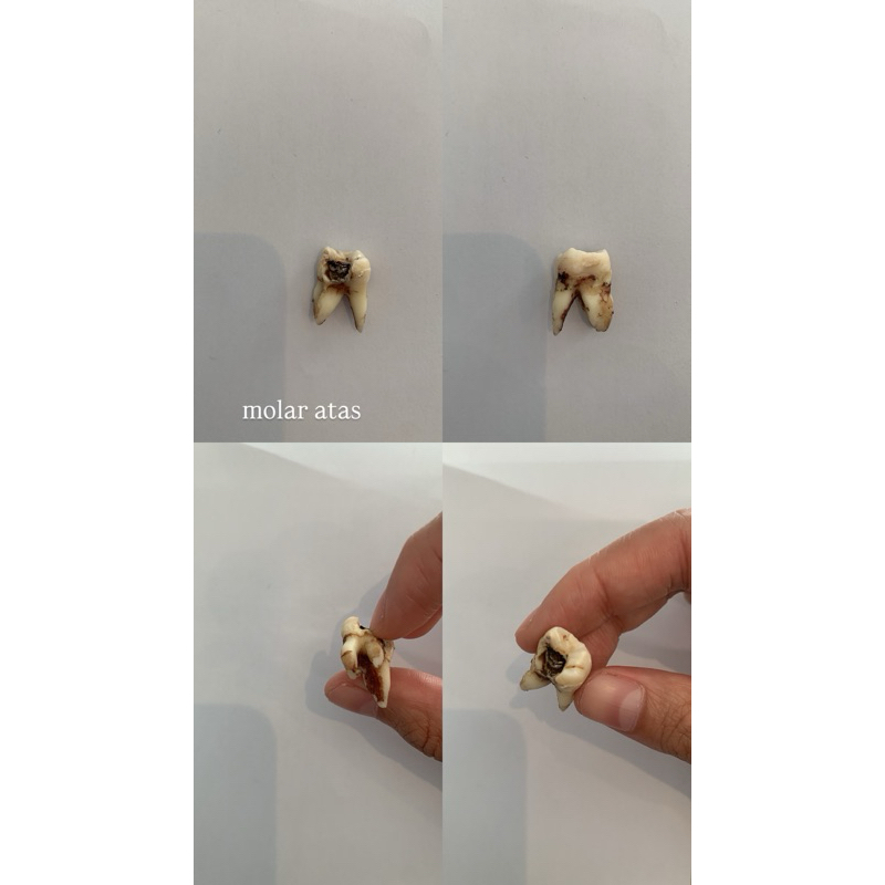 Gigi Molar Atas