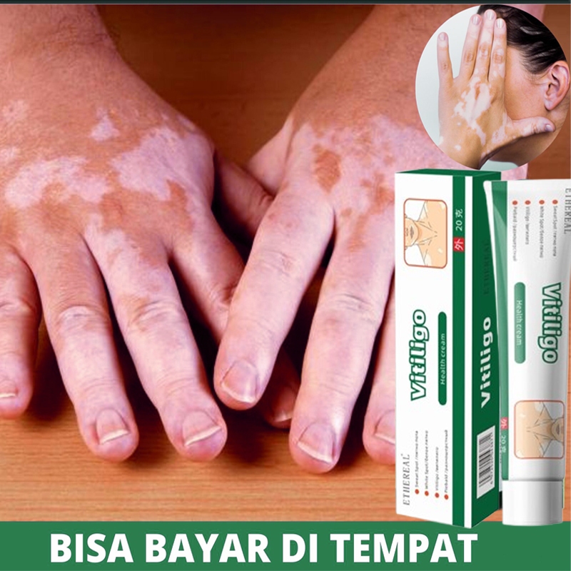 ORIGINAL Obat Penghilang Vitiligo Salep Krim Vitiligo Bintik Putih Salep vitiligo Obat vitiligo untu