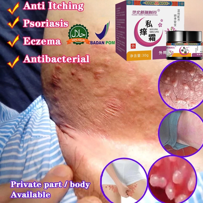 Salep gatal paling ampuh 30g Salep gatal pada miss v Anti jamur Salep gatal selangkangan Salep Mengh