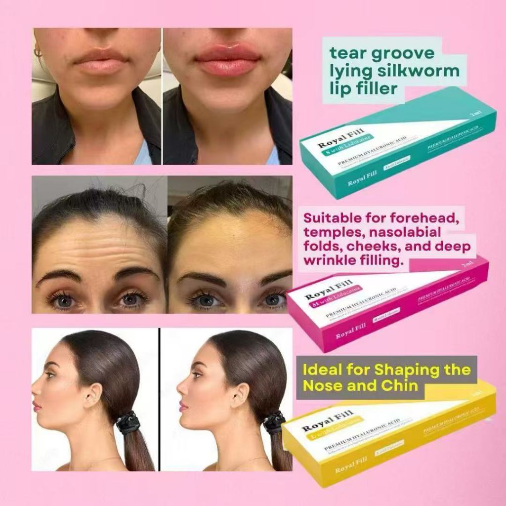 Filler HA 2ml - Untuk Wajah, Bibir & Dagu
