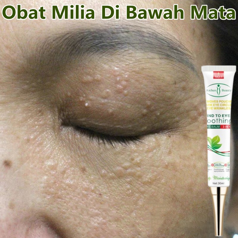 Penghilang milia paling ampuh Milia di bawah mata Obat milia Eye cream kantung mata Milia remover
