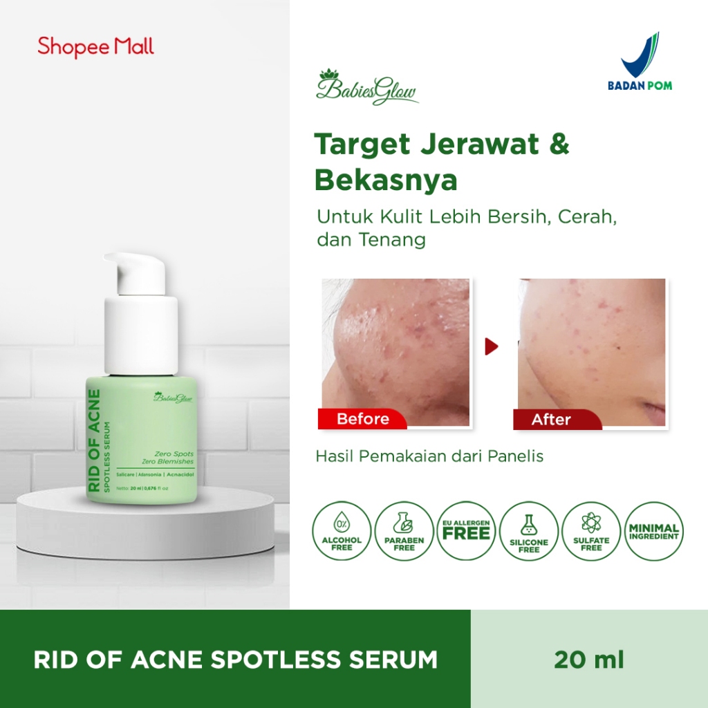 Babies Glow Rid of Acne Spotless Serum