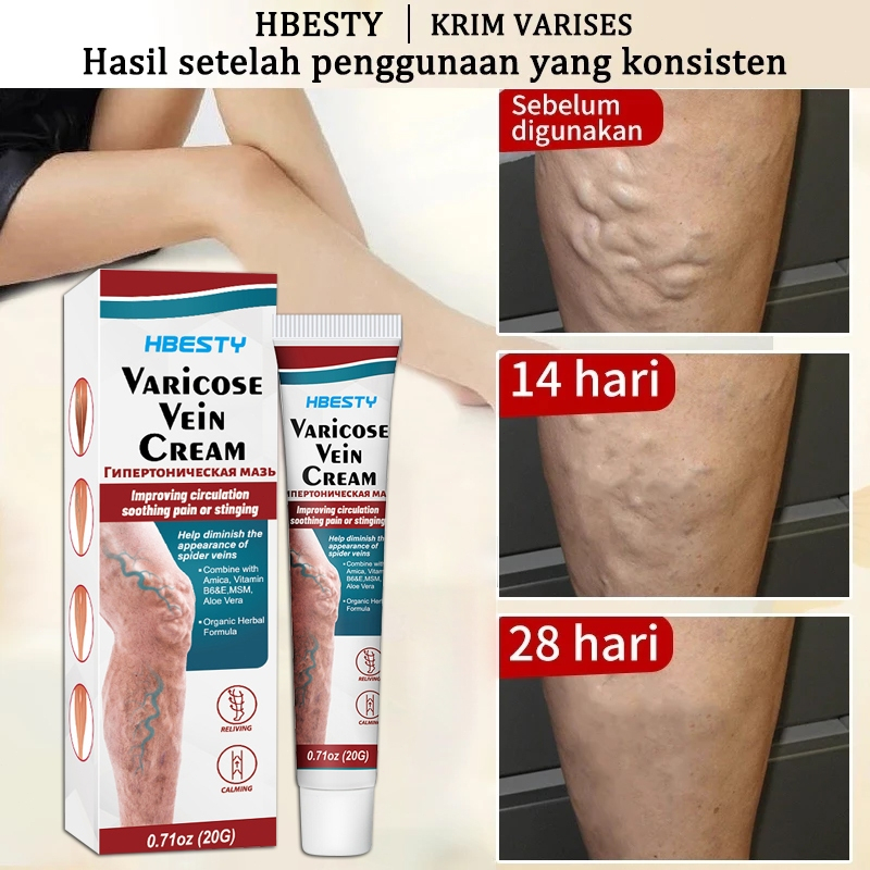 Reydokurniawan 100% AsliObat Varises Varicose Veins Cream Penghilang Varises, Obat Varises Original