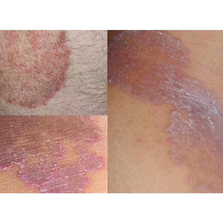 ORIGINAL - Salep Oles Anti Jamur Kulit - TERBUKTI AMPUH