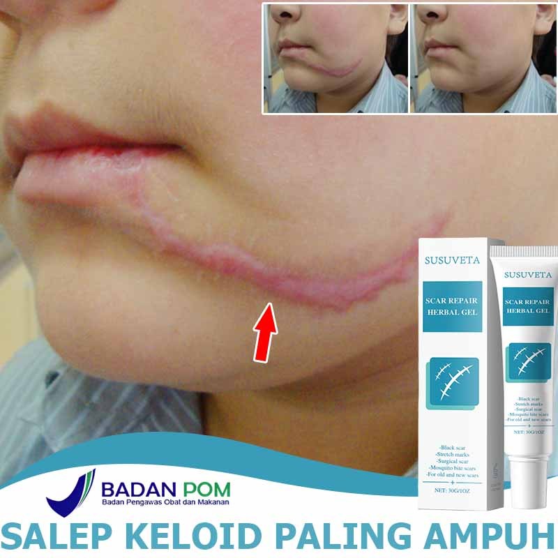 Penghilang bekas luka hitam koreng Bio herbal penghilang bekas luka Obat keloid Salep keloid paling 