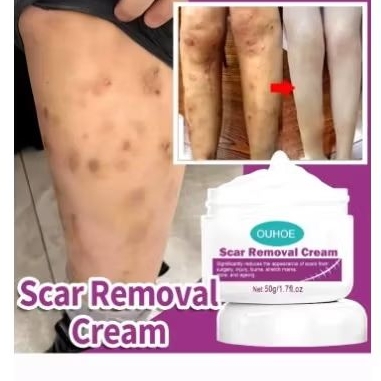 Krim Penghilang bekas korengan Krim penghilang bekas luka bakar bekas cacar cream penghilang luka ba