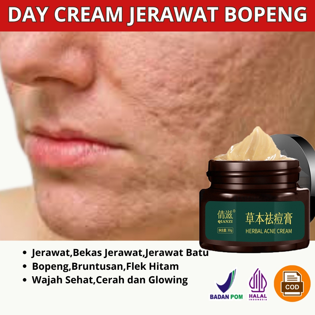 Qianzi obat jerawat dan bekas jerawat penghilang jerawat 30g Herbal Acne Removal Cream Untuk Pria da