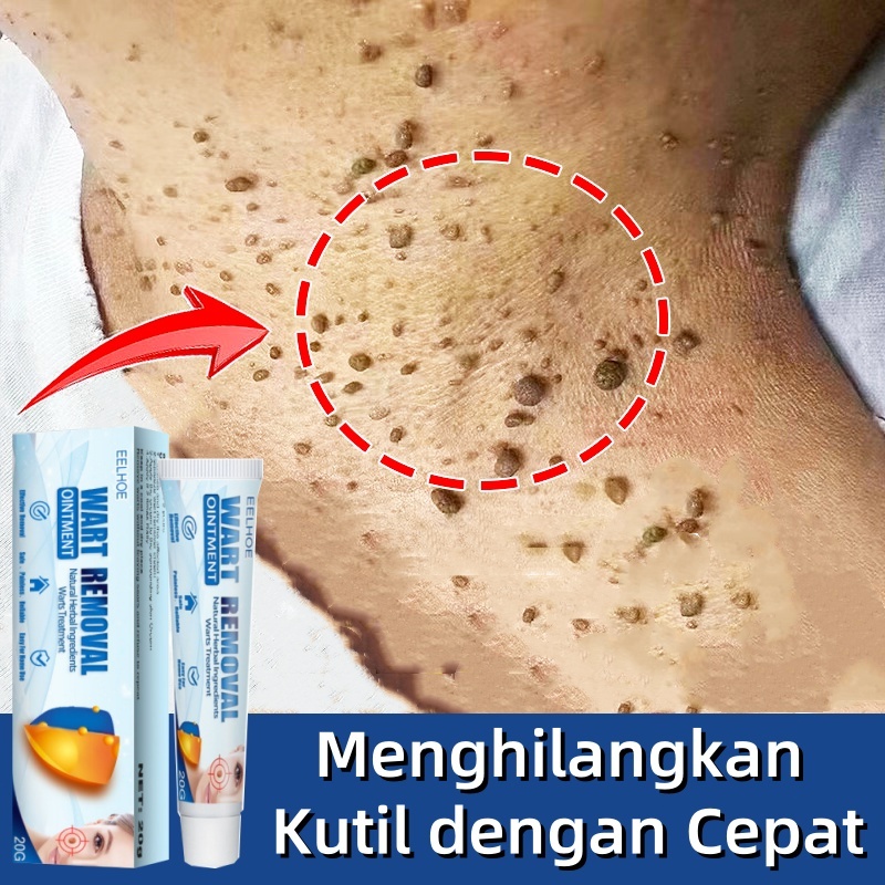 Obat kutil Salep kutil paling ampuh Penghilang kutil Wart removal Ointment Menghilangkan Kutil Wajah