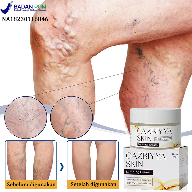 Valesin varises Obat varises Salep varises paling ampuh 30g obat varises original obat varises di