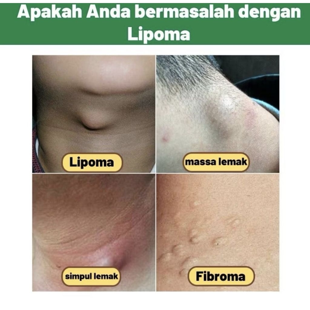 SALEP KRIM BENJOLAN LIPOMA Jinak / uci uci LIPOMA CREAM benjolan kaki payudara leher