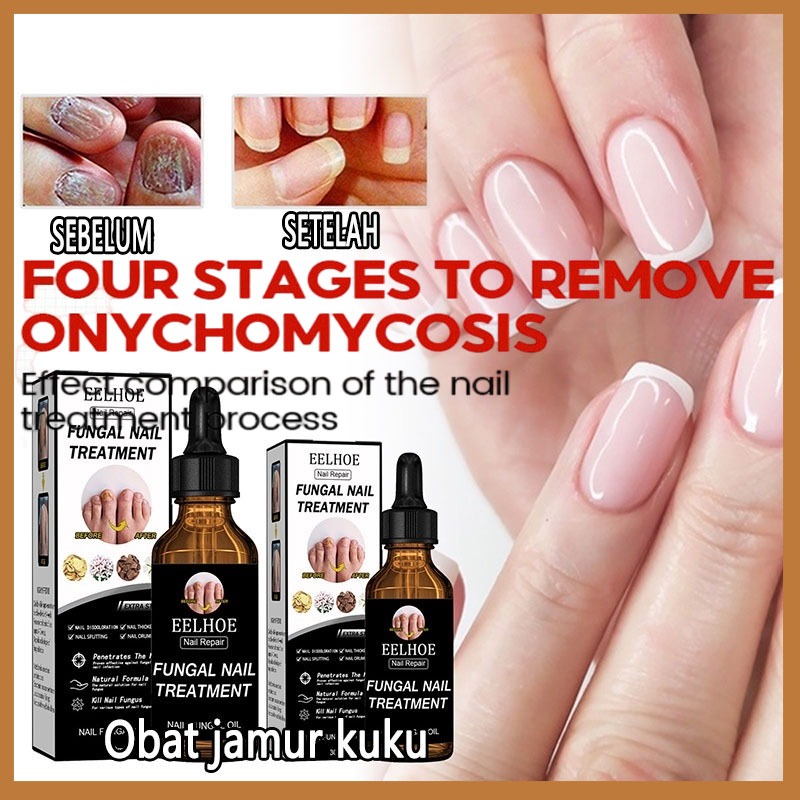 Obat Jamur Kuku / Salep untuk Nanah di Kuku Kaki