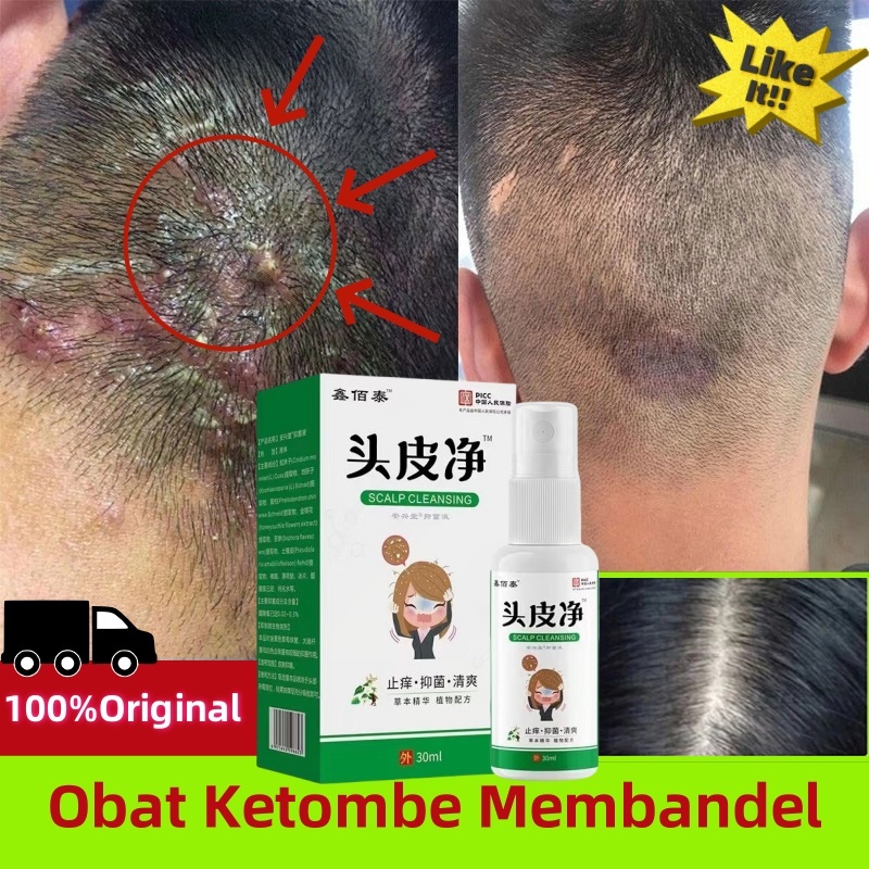 Semprotan Kulit Kepala 30ml Obat Ketombe Rambut Berkerak Kulit Kepala Gatal Ketombe Berkerak Ketombe