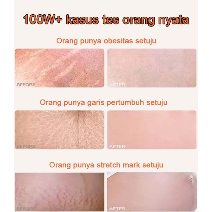 Stretch Mark Cream Penghilang Strechmark Stretch Mark Oil Cream Stretch Mark Paling Ampuh Krim