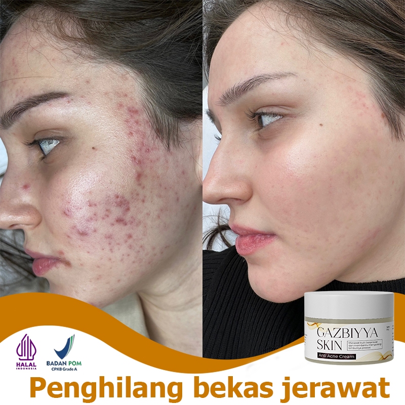 Obat jerawat menghilangkan bekas jerawat penghilang bekas jerawat 30g obat totol jerawat penghilang 