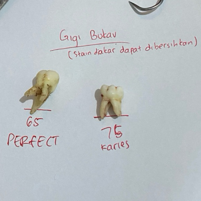 GIGI BUKA KAVUM / BUKAV MOLAR ANAK PEDO 65 DAN 75 RAHANG ATAS DAN RAHANG BAWAH
