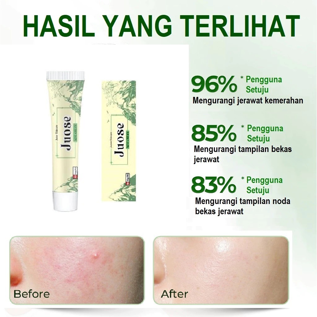 Obat Cina Salep China Ampuh JerawatJuose Skincare Acne Cream - Acne Spot Treatment Cream Obat Totol 