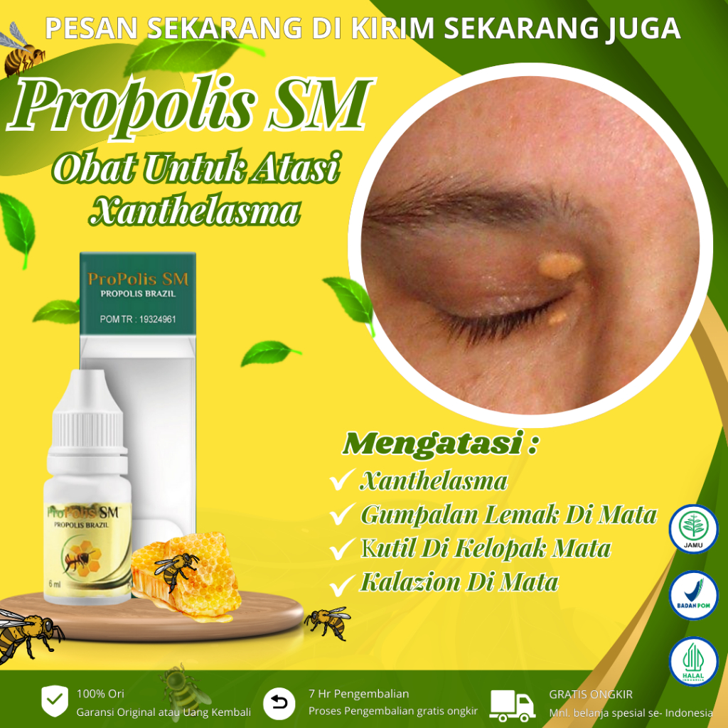 Propolis Sm - Obat Xanthelasma, Obat Penghilang Gumpalan Lemak Di Kelopak Mata, Salep Xanthelasma