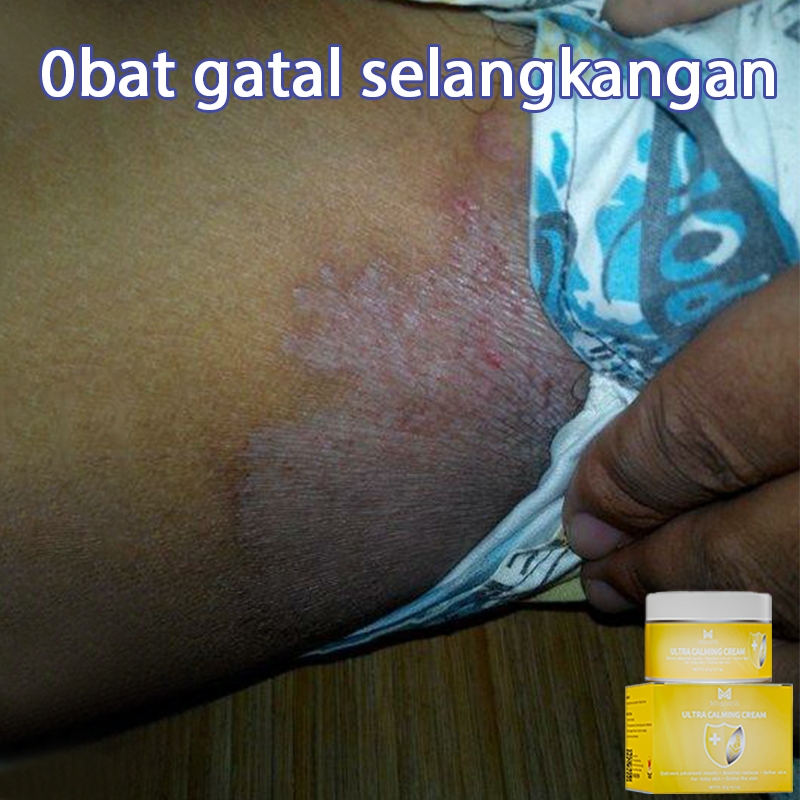 Obat gatal salep gatal selangkangan salep gatal china paling ampuh salep eksim kering paling ampuh 2
