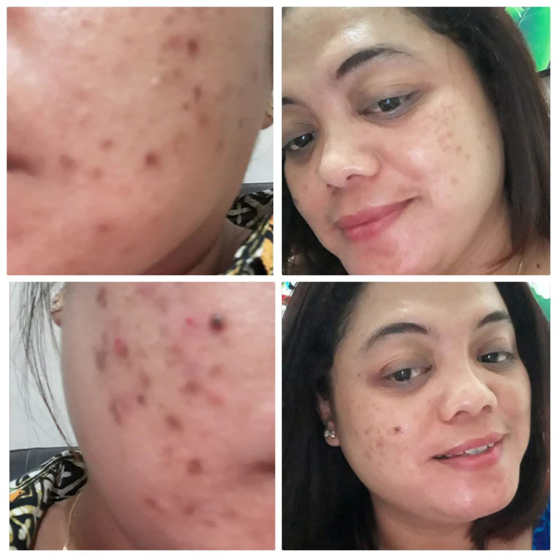 PHARMASKIN SOLUTION Paket Full Treatment Acne Glowing Series Skincare | Obat Jerawat | Salep Jerawat