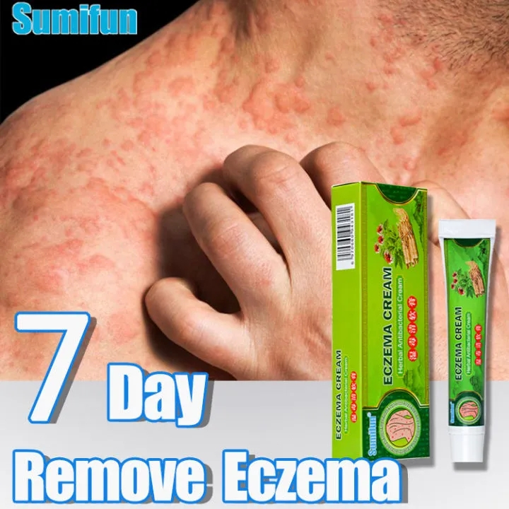 Salep Khusus Psoriasis Obat Gatal Eksim Krim psoriasis paling ampuh Kulit Kepala Psoriasis Tangan Ti