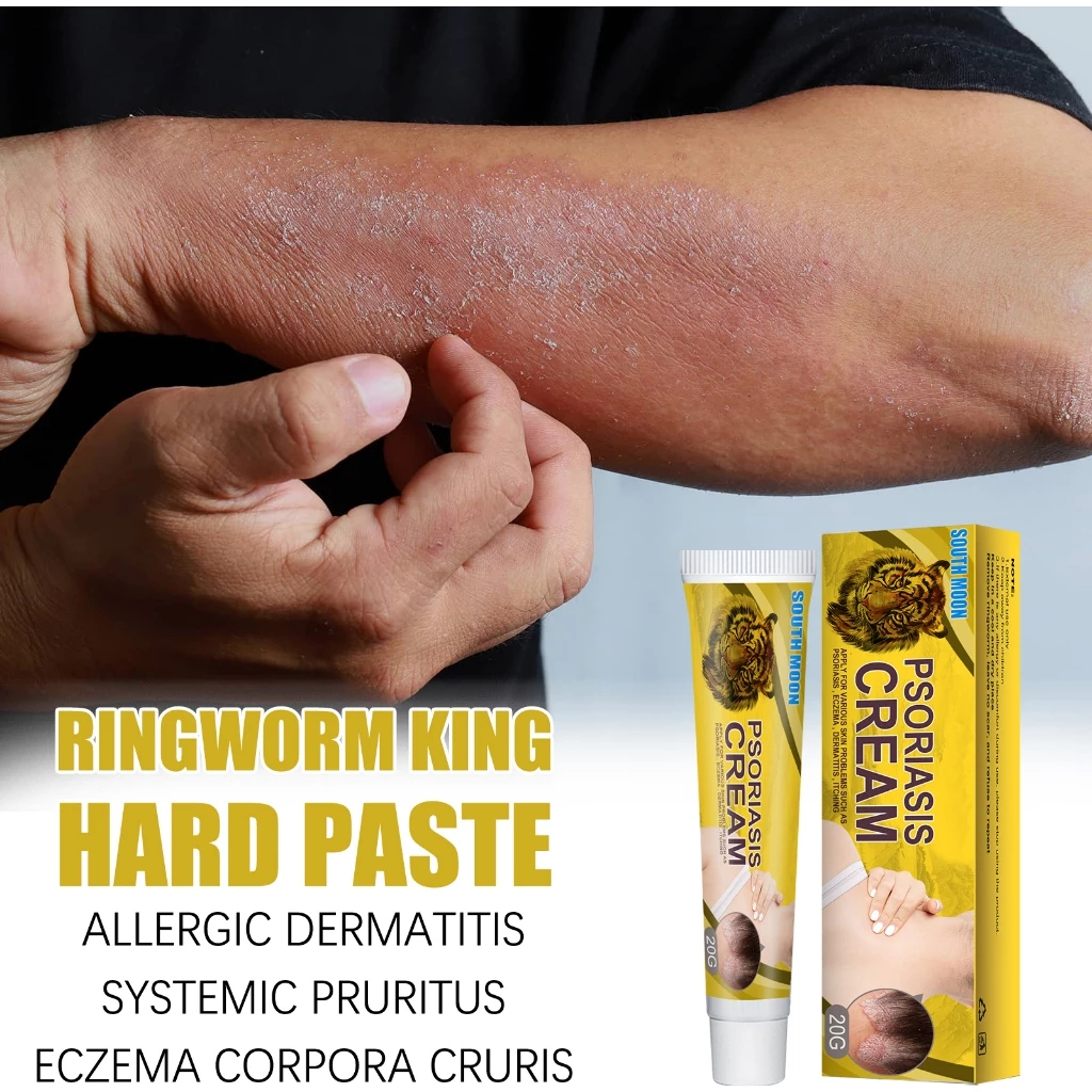 South Moon Psoriasis Cream Salep Psoriasis 20g Salep Psoriasis Ampuh Psoriasis Cream Ori Salep Kulit