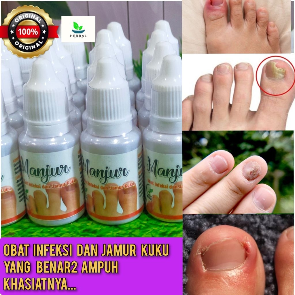 Obat kuku cantengan jempol kaki tangan, infeksi bakteri dan jamur bau gatal kuku sakit bernanah beng