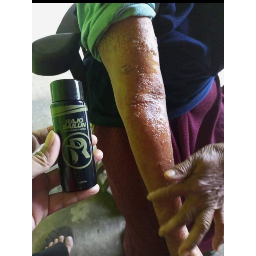 

RAJO SAILUN HERBAL : Sehat tanpa ribet!