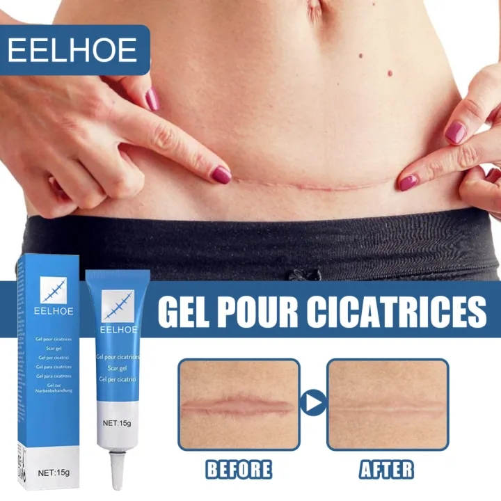 EELHOE salep bekas luka Ampuh salep penghilang bekas luka ori/obat penghilang bekas luka koreng hita