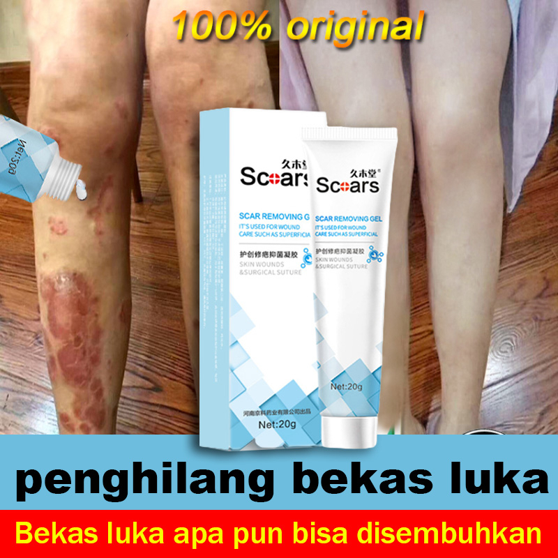 Salep penghilang bekas luka Penghilang bekas luka hitam koreng Penghilang bekas gigitan nyamuk