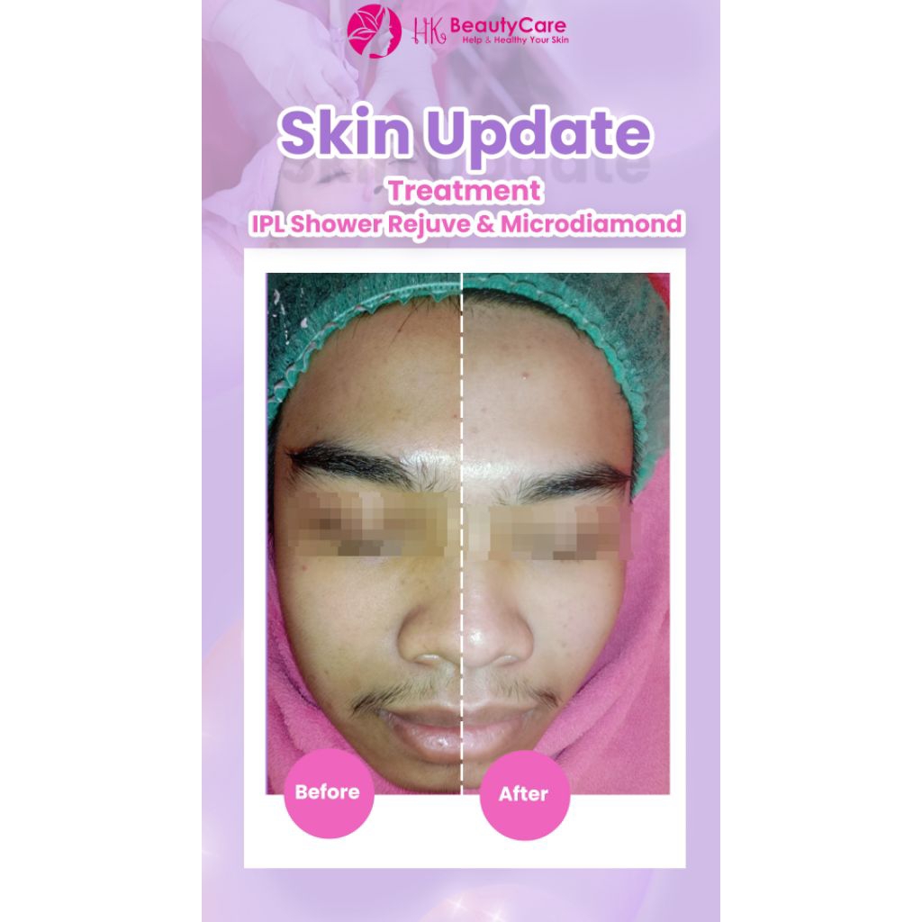 Treatment HK Beautycare - IPL