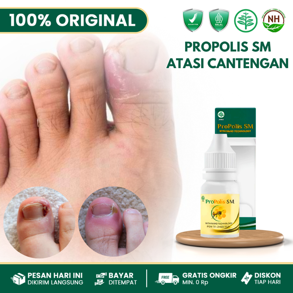 Propolis Sm Original - Obat Cantengan Jempol Kaki Bengkak - Obat Jamur Kuku Kaki - Obat Kuku Bengkak