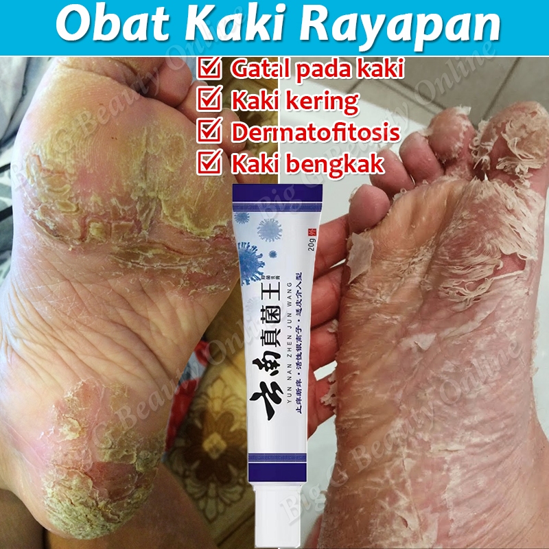 Obat Kaki Rayapan Krim Obat Kulat Air Kaki Salep Kaki Rayapan Dan Bau Penghilang Bau Kaki Obat Bau K